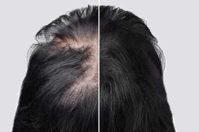 Signs you may be developing a bald spot on your head
