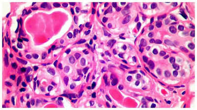 Cancer: Can a Plutonium leak cause Cancer? |