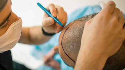 Another techie dies post hair transplant by same Kanpur doctor | Kanpur News