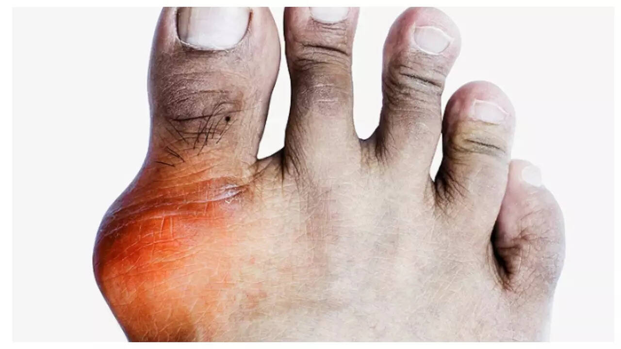 7 tips to bring down Uric Acid levels in one month