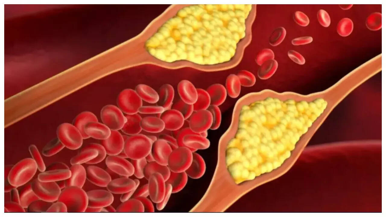 6 symptoms of high cholesterol seen in body and face